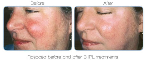 rosacea before and after treatment